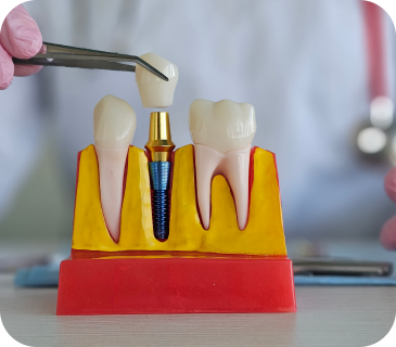Implantátumok